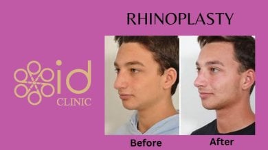 Before and after ultrasonic rhinoplasty results at ID Clinic Bangkok, improved nose shape