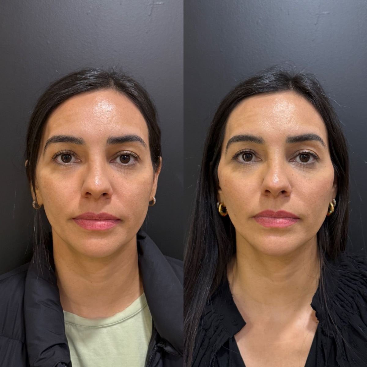 Resultados antes y después de lipofilling facial en Dr. Alexandro Aguilera - Plastic Surgery