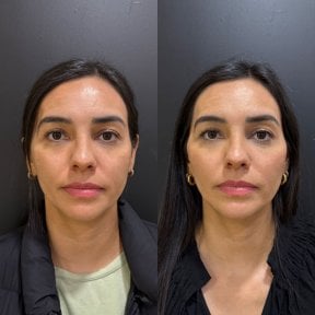 Before and after facial fat transfer results at Dr. Alexandro Aguilera - Plastic Surgery clinic