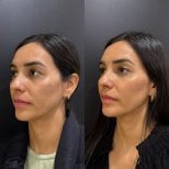 Before and after facial fat transfer results at Dr. Alexandro Aguilera - Plastic Surgery clinic