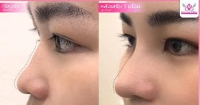 Результати ринопластики до і після в Somchai Clinic, покращена форма носа і профіль