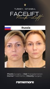 Before and after endoscopic facelift results at Memorial Bahçelievler Hospital, neck lift effect