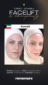 Before and after endoscopic facelift results at Memorial Bahçelievler Hospital, facial rejuvenation