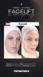 Before and after endoscopic facelift results at Memorial Bahçelievler Hospital, facial rejuvenation