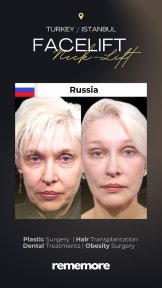 Before and after endoscopic facelift results at Memorial Bahçelievler Hospital, facial rejuvenation