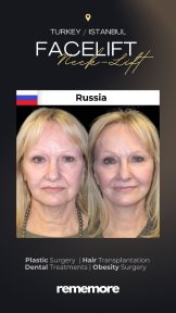 Before and after endoscopic facelift results at Memorial Bahçelievler Hospital, facial rejuvenation