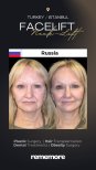 Before and after endoscopic facelift results at Memorial Bahçelievler Hospital, facial rejuvenation