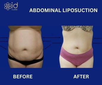 Before and after abdominal liposuction results at ID Clinic Bangkok, visible slimmer waistline