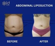 Before and after abdominal liposuction results at ID Clinic Bangkok, visible slimmer waistline
