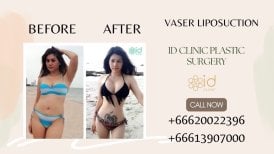 Before and after VASER liposuction results at ID Clinic Bangkok, visible body contouring