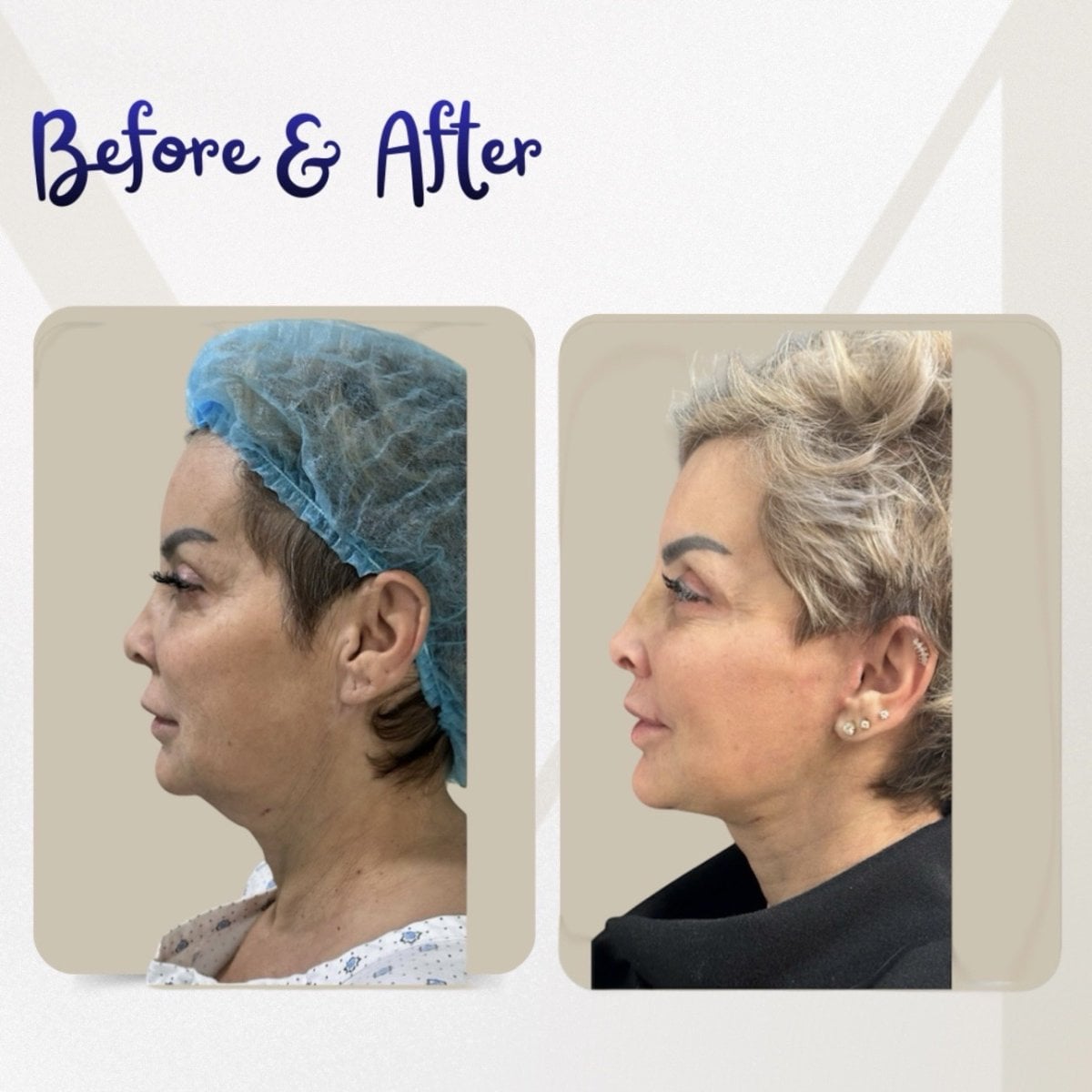 نتيجة شد الوجه العميق قبل وبعد في Dr. Michel Salameh - Plastic And Aesthetic Surgery