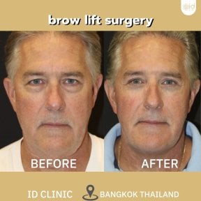 before-after photo brow-lift