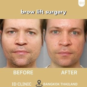 before-after photo brow-lift