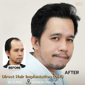 before-after photo dhi-hair-transplantation