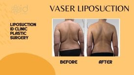 Résultats avant et après Vaser liposuccion à ID Clinic Bangkok, remodelage du dos visible