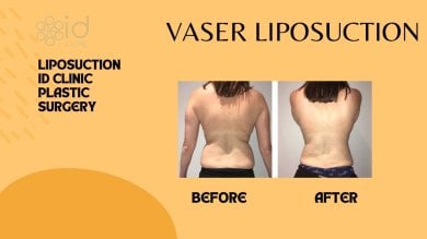 Résultats avant et après liposuccion Vaser à ID Clinic Bangkok, amélioration du contour du dos