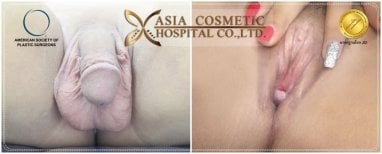 Before and after male to female (MTF) surgery results at Asia Cosmetic Hospital, gender confirmation