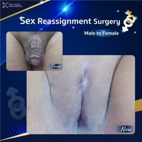 Male to female sex reassignment surgery before and after results at Asia Cosmetic Hospital