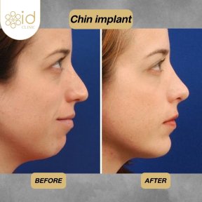 before-after photo mini-facelift