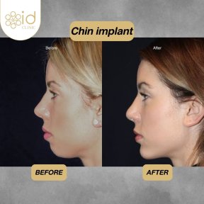 before-after photo mini-facelift