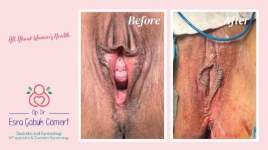 Before and after vaginoplasty results at Dr. Esra Cabuk Comert's Clinic, improved vaginal appearance