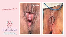 Before and after vaginoplasty results at Dr. Esra Cabuk Comert's Clinic, improved vaginal appearance