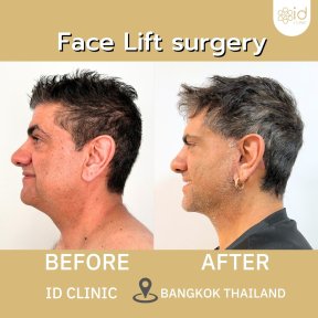 before-after photo mini-facelift
