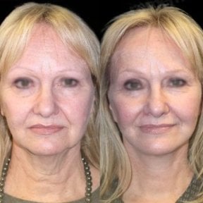 before-after photo endoscopic-facelift