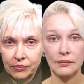 before-after photo endoscopic-facelift