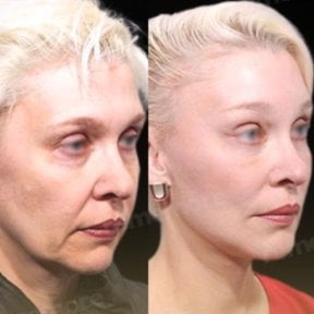 before-after photo endoscopic-facelift
