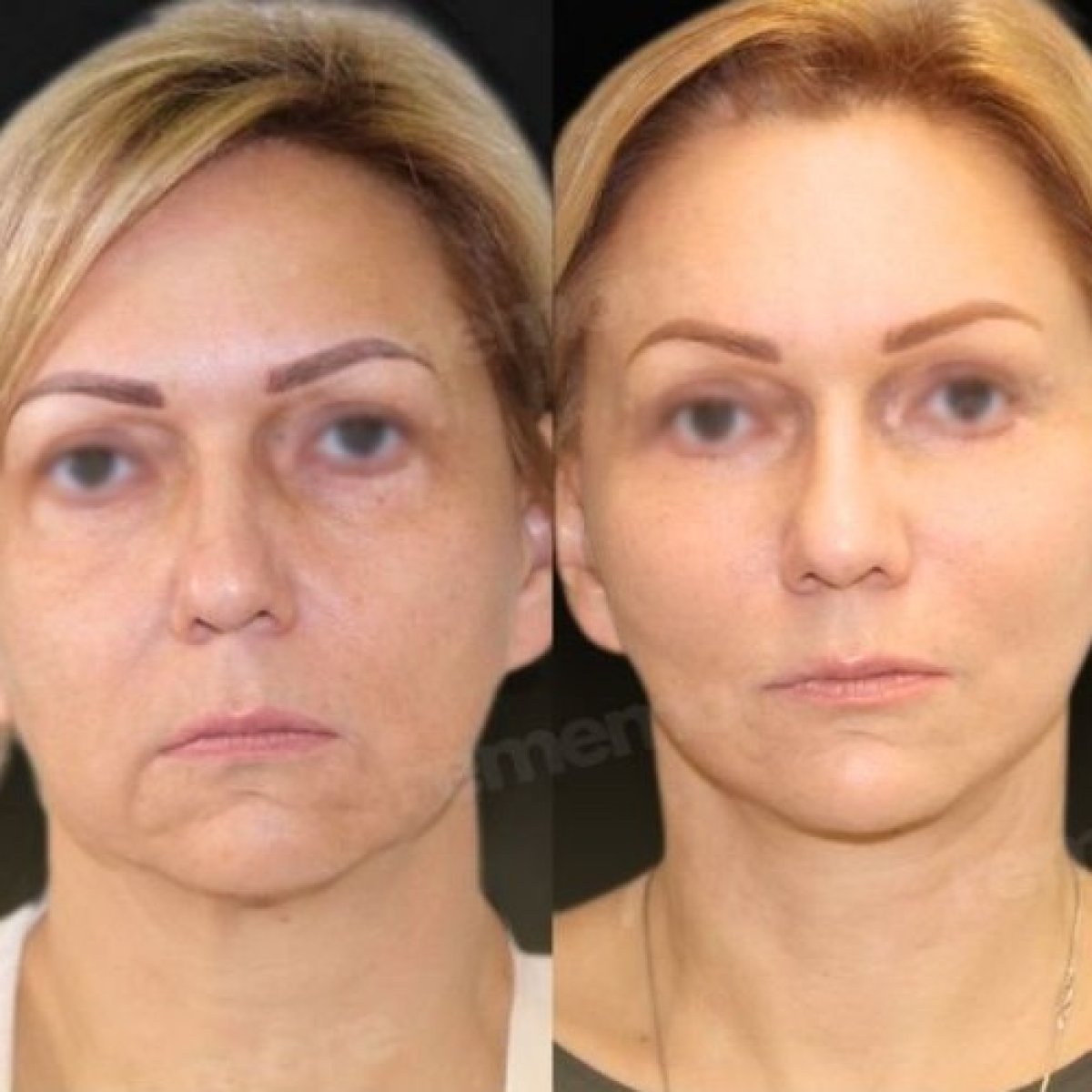 Resultados de lifting endoscópico facial antes y después en Memorial Bahçelievler Hospital