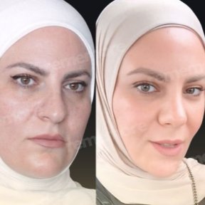 before-after photo endoscopic-facelift