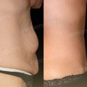 Abdominal etching before and after results at Memorial Göztepe Hospital, defined abs contour