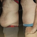 Before and after abdominal etching results at Memorial Göztepe Hospital, defined six pack abs