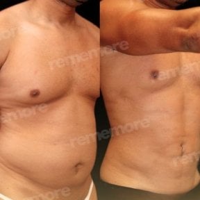 Before and after abdominal etching results at Memorial Göztepe Hospital, defined six pack abs