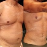 Before and after abdominal etching results at Memorial Göztepe Hospital, defined six pack abs