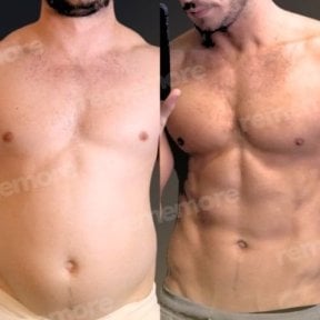 Before and after abdominal etching results at Memorial Göztepe Hospital, defined six pack abs