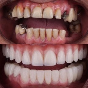before-after photo dental-crown-installation