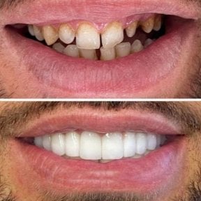 before-after photo dental-crown-installation