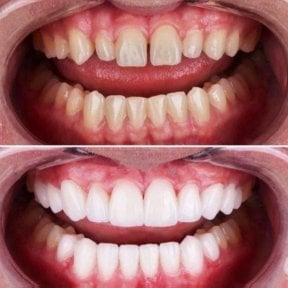 before-after photo dental-crown-installation