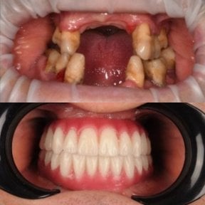 Résultat avant/après implants All-on-6 à la RIKOTA Dental Clinic, restauration complète du sourire