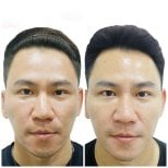 Before and after fillers injection result at Somchai Clinic, facial volume enhancement