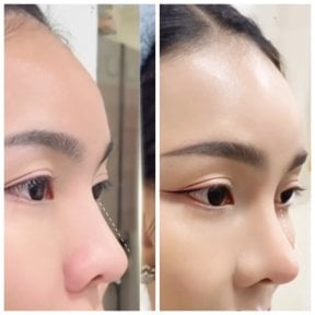 Before and after rhinoplasty results at Somchai Clinic, nose reshaping with natural contour