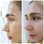 Vorher-nachher-Ergebnis der Nasenkorrektur in der Somchai Clinic, natürliche Kontur