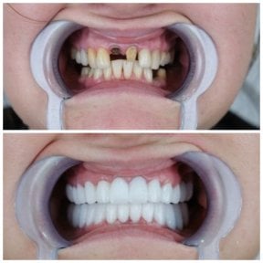 before-after photo dental-crown-replacement