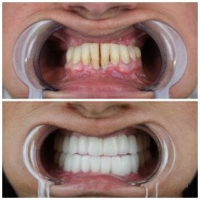 before-after photo dental-crown-replacement