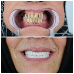 before-after photo dental-crown-replacement