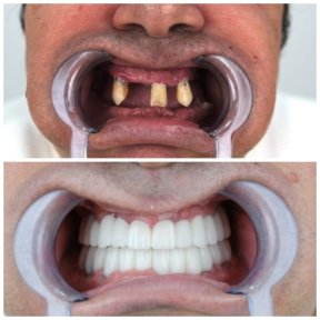 before-after photo dental-crown-replacement