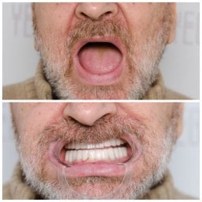 before-after photo dental-crown-replacement