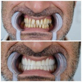 before-after photo dental-crown-replacement